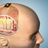 This image shows how a thin film of sensors can be applied to the brain during surgery.